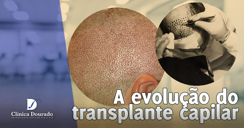 A evolução do transplante capilar