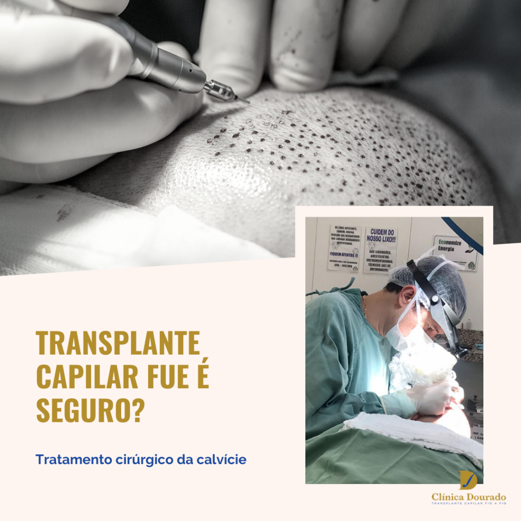 transplante capilar FUE é seguro?