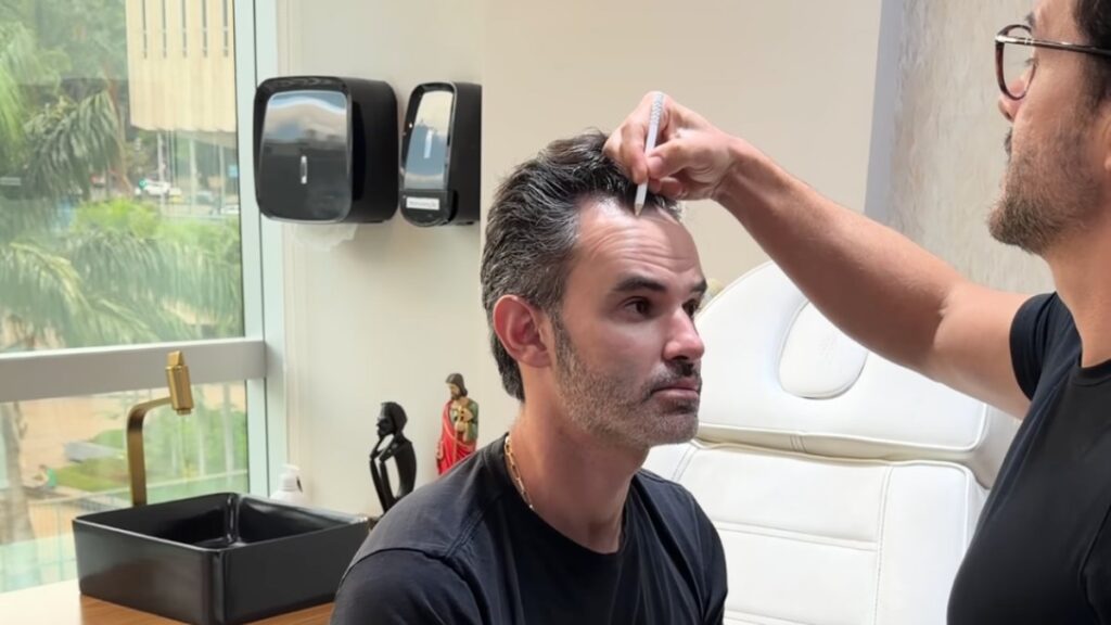 Nicolas Low Cars na avaliação para o transplante capilar, com o desenho da linha frontal